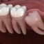 affordable wisdom teeth removal