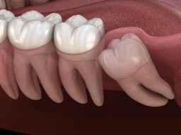 affordable wisdom teeth removal